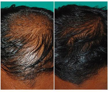 Second image of Ayurvansh Hair Growth & Hair Fall Control Oil
